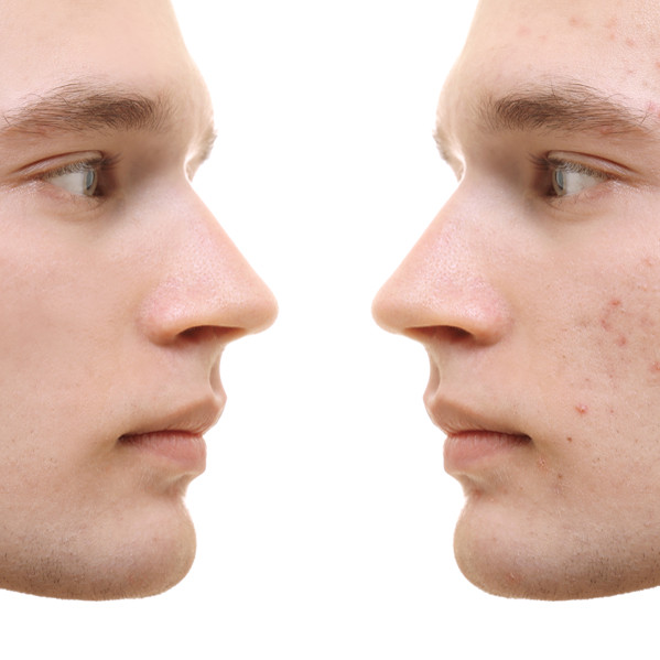 skin-bemishes-2web